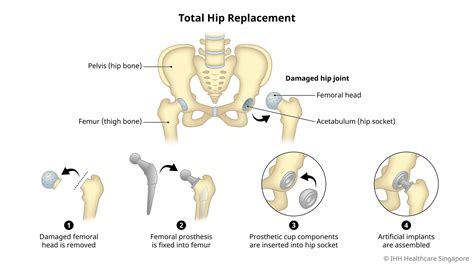 hip replacement greenwich|Planning for Joint Replacement Surgery .